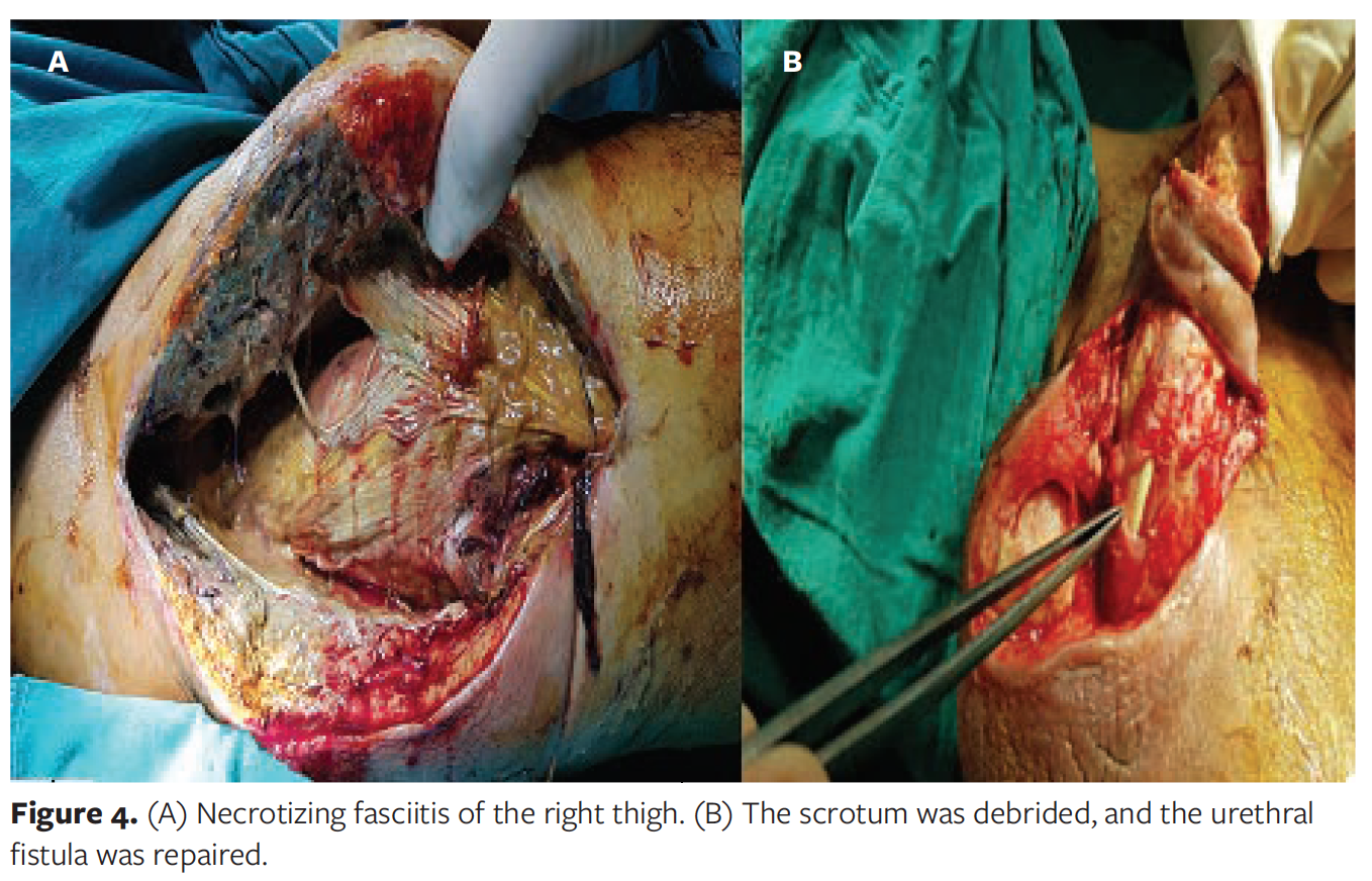 Thigh Abscess Secondary to Intra-abdominal Pathologic Conditions