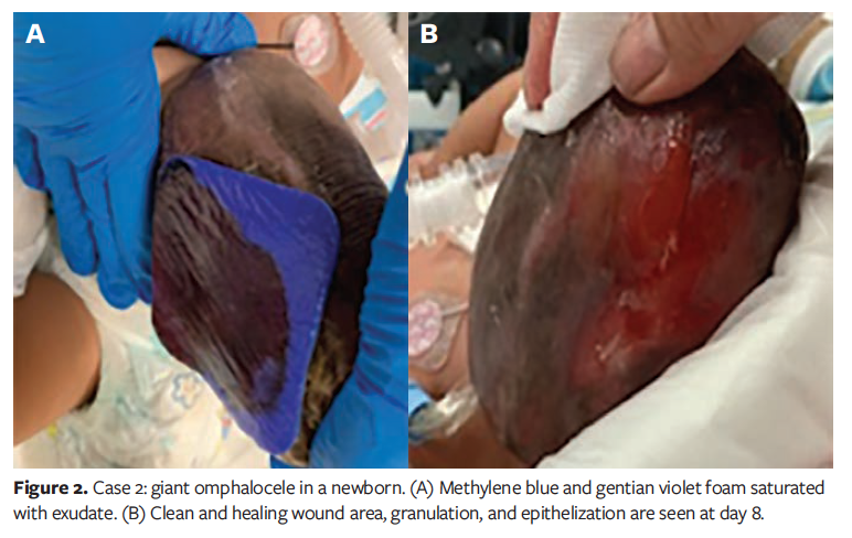 Pediatric, Neonatal Wounds With Methylene Blue and Gentian Violet