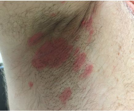 Inverse psoriasis