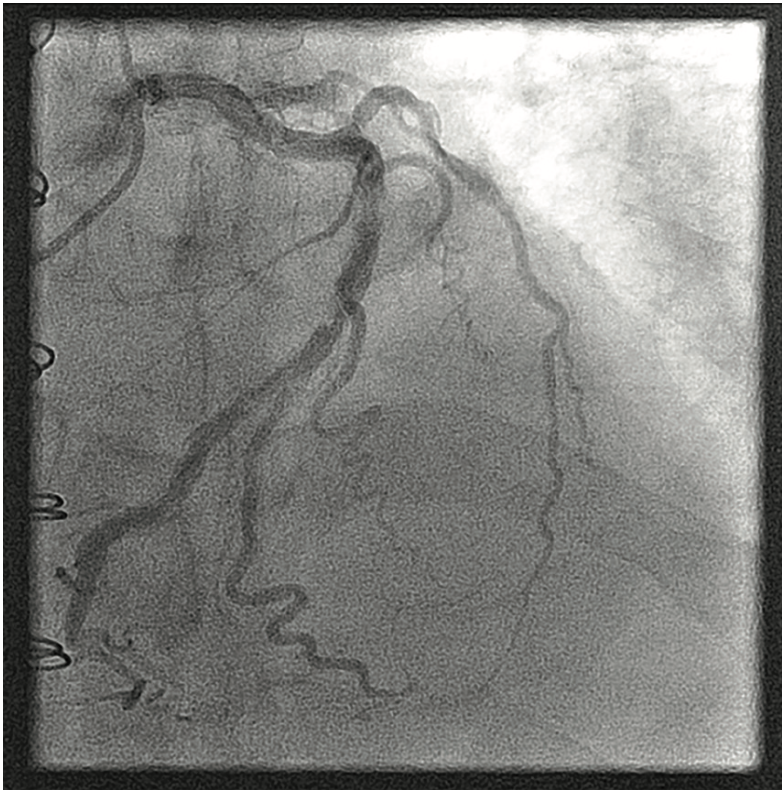 Twisted Turns to Traverse — Our Approach to Upper Extremity Tortuosity