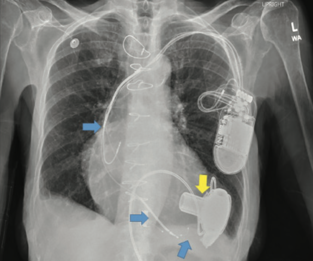 Late Right Heart Failure After Left Ventricular Assist Device Implant ...