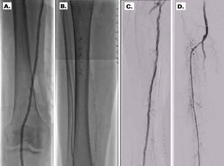 Endovascular Limb Salvage Therapy | VDM