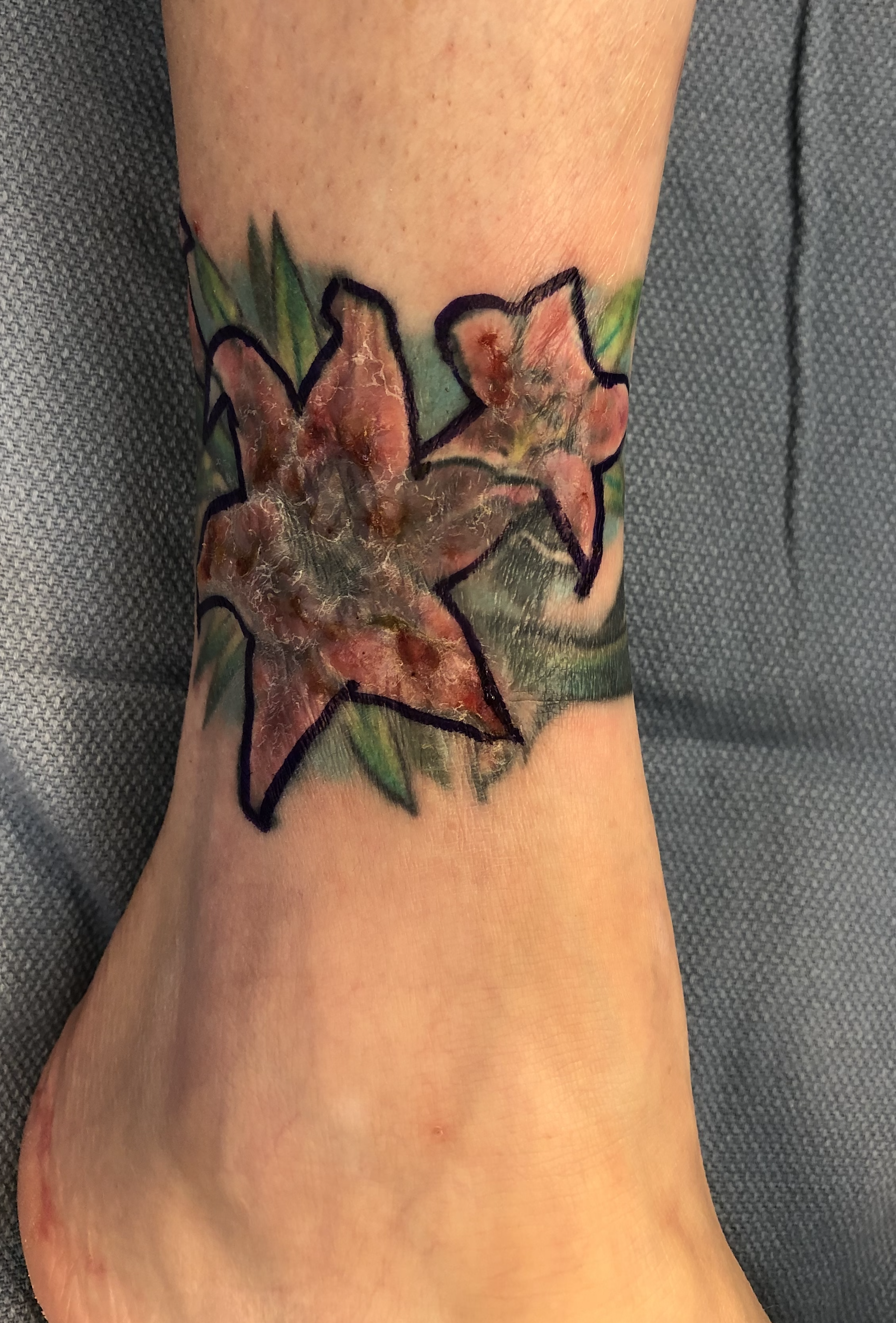 Surgical Excision and Reconstruction of Tattoo Following Hypersensitivity, image size:3000x4430