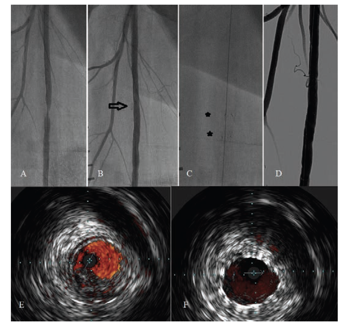 Ivus Disection Identifying and Repairing Dissections Using IVUS | VDM