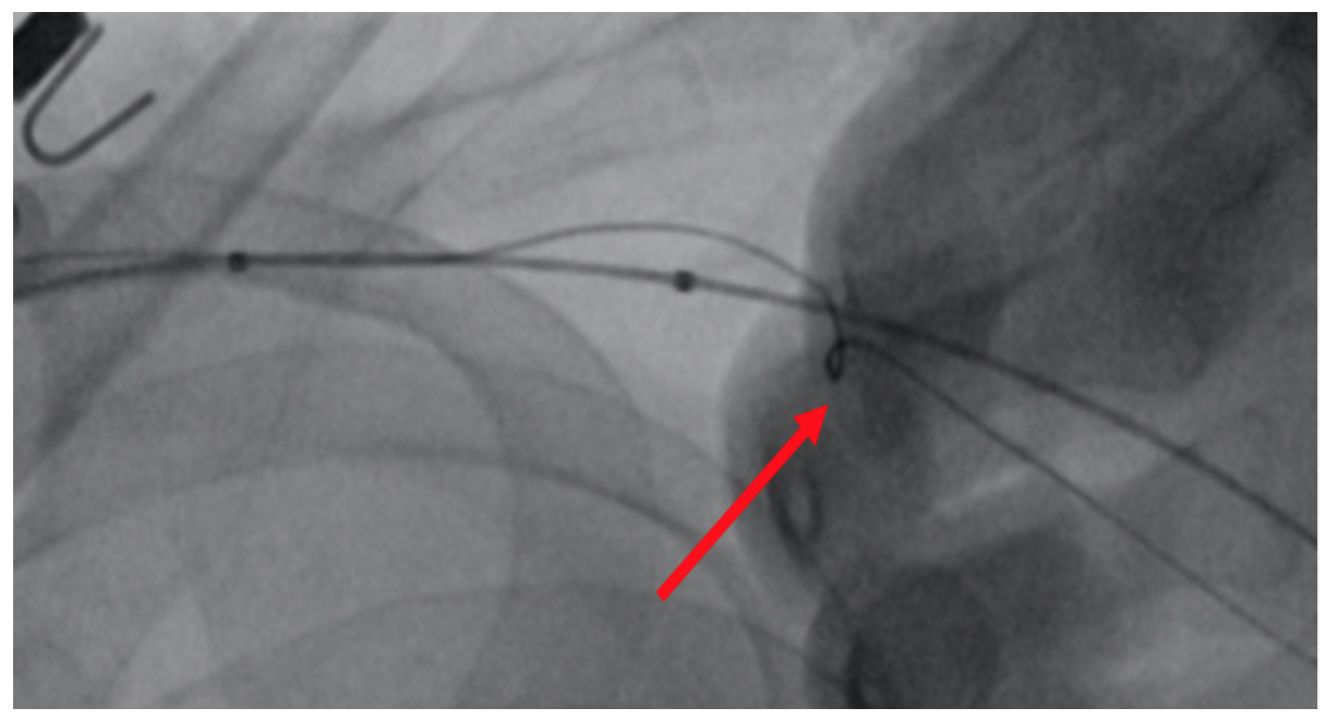 Difficult Percutaneous Closure of Axillary Access