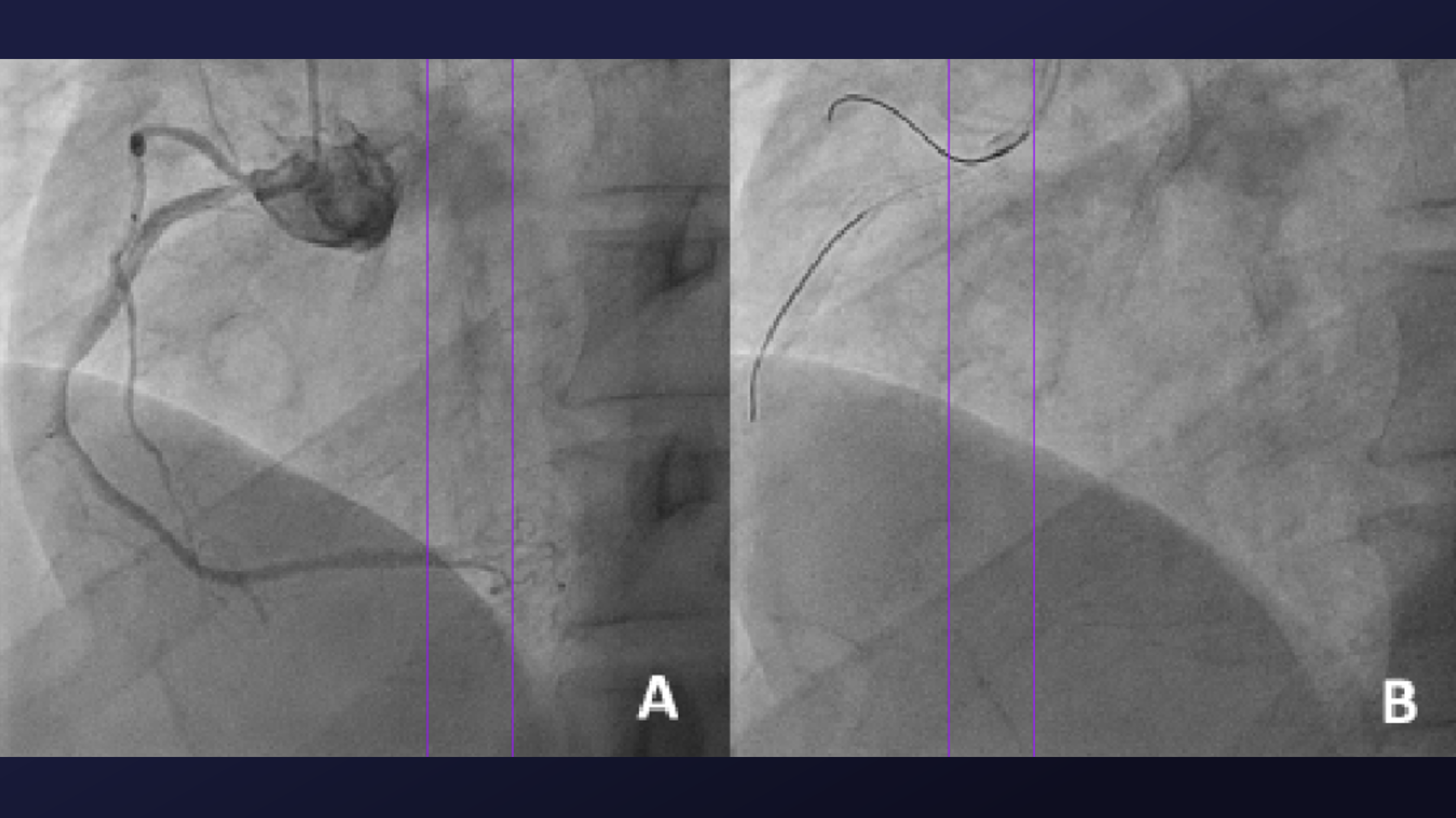 Aortogene Panel Technique to Access Protruding Aorto-Ostial Stent | JIC