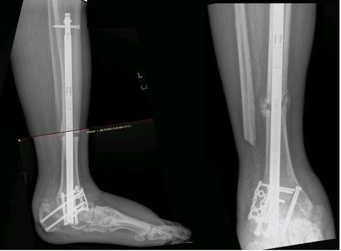Use of a Magnetic Intramedullary Nail for TTC Arthrodesis | Podiatry Today