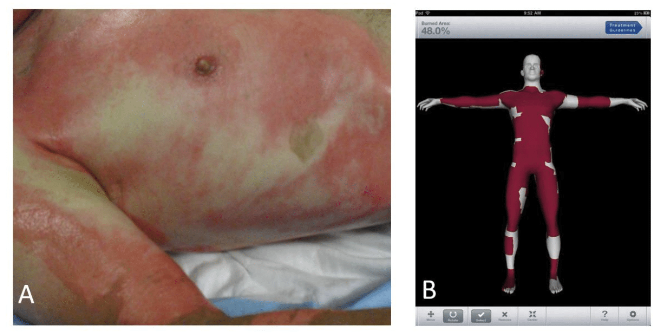 Normal Burn Pattern Skeleton Burn Size Estimation: A Critical Component of Burn Care