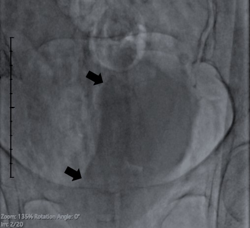 Bladder Indentation Sign: A Stitch in Time Can Save Nine