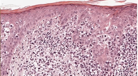 Challenges in Diagnosing Cutaneous T-cell Lymphoma (CTCL)