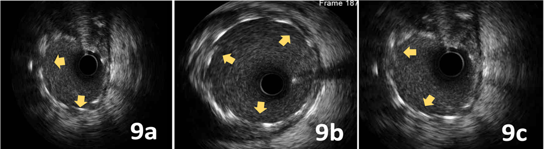 King Ghidorah Technique for a Trifurcation Lesion in a Very High-Risk ...