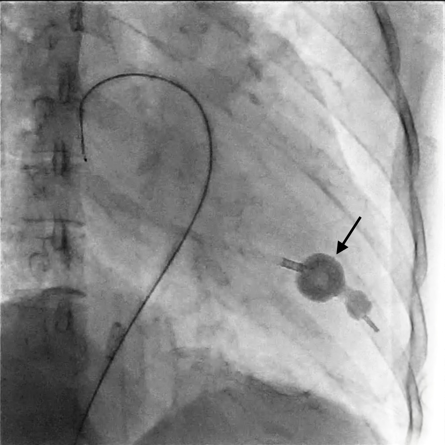 Impasse Sign in Balloon Mitral Valvotomy