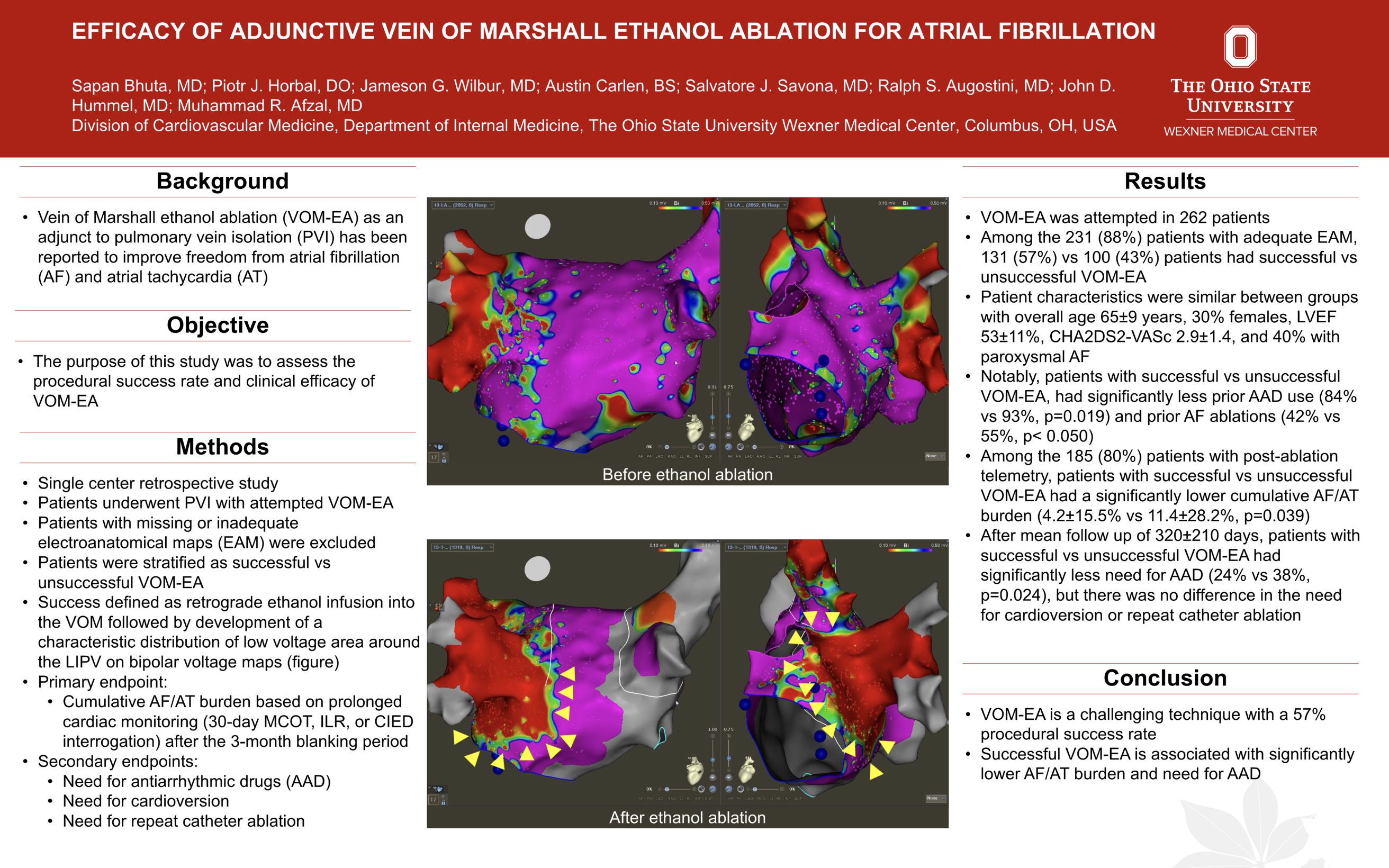 Efficacy of Adjunctive Vein of Marshall Ethanol Ablation for Atrial Fibrillation