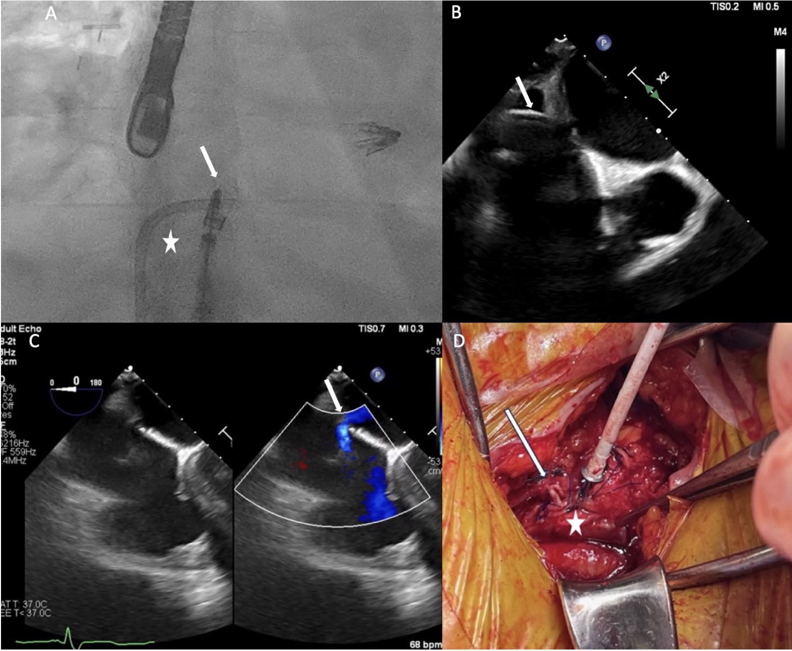 A Novel Exit Strategy for Removal of a Mitraclip Device From the Left ...