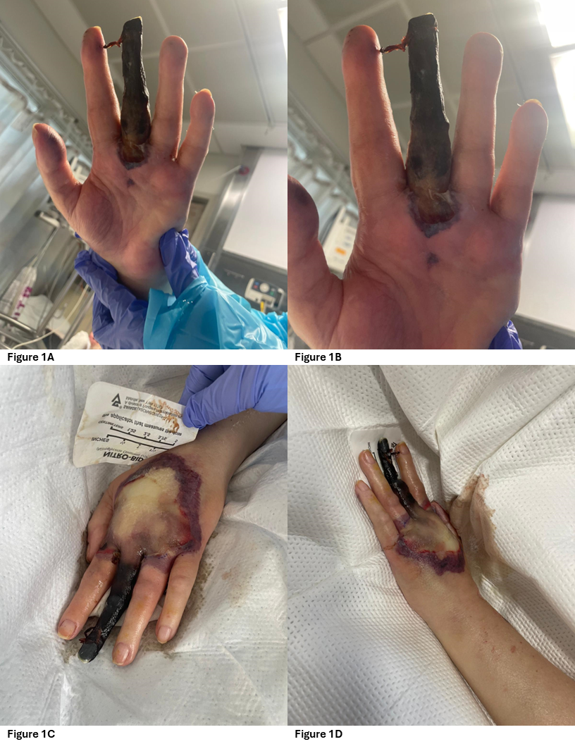 Prolonged Acute Kidney Injury and Symmetrical Peripheral Gangrene: A Rare  Case Report of Acute Promyelocytic Leukemia, image size:816x1056