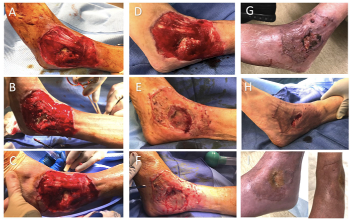 chewing tobacco and wound healing Nicotine Accelerates Angiogenesis in Genetically Diabetic Mice How Smoking Affects Wound Healing