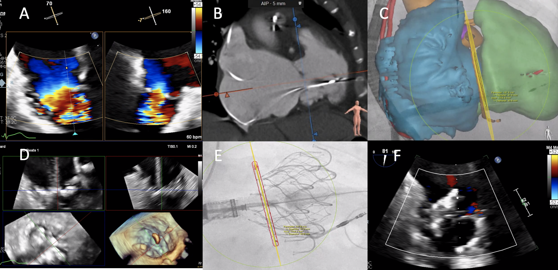 Transcatheter Tricuspid Valve Replacement for Rheumatic Tricuspid Valve ...
