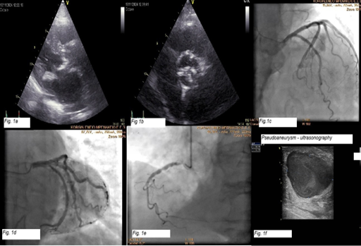 Large Radial Artery Pseudoaneurysm Following Diagnostic Coronary ...