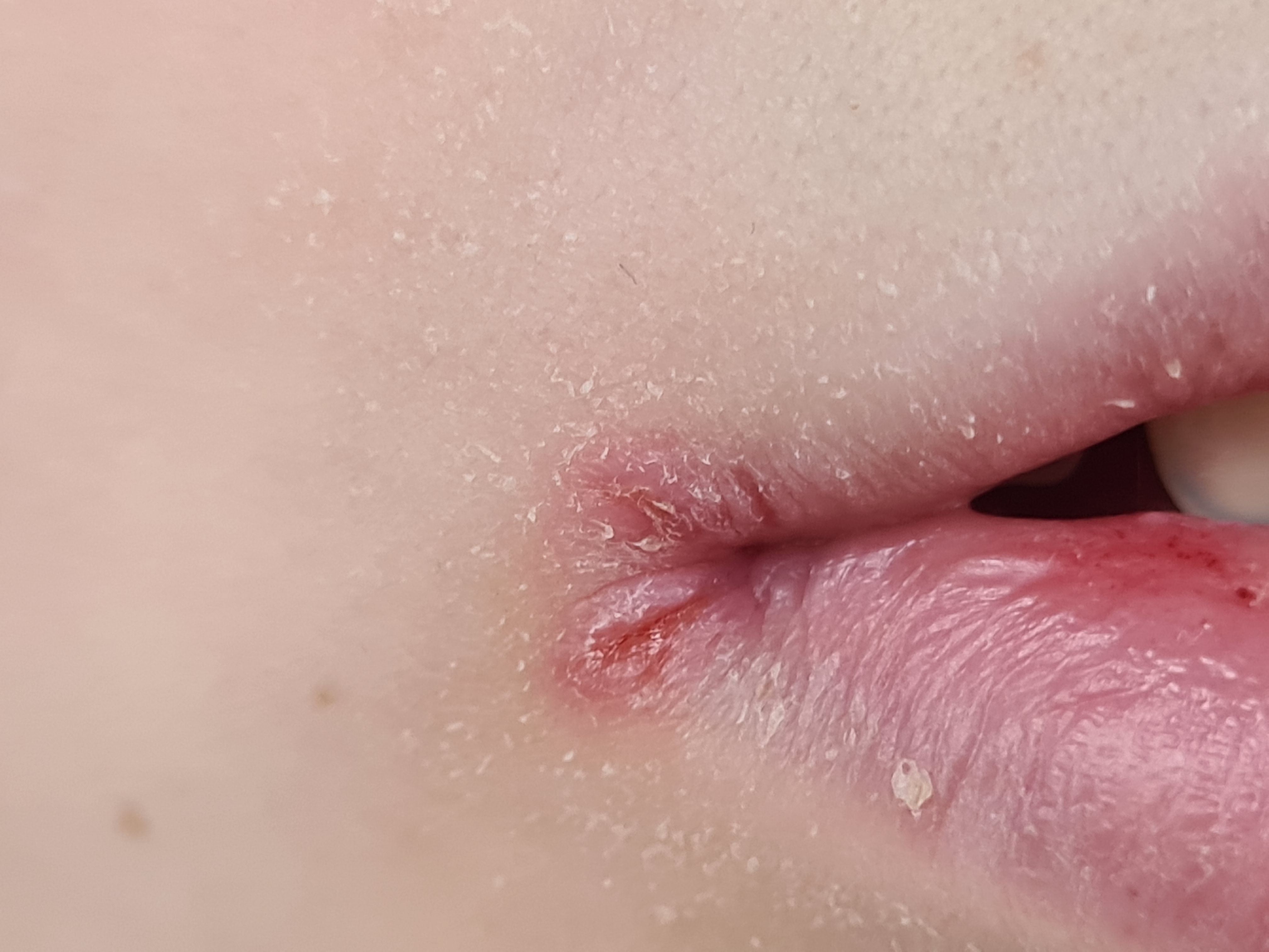 Hmp Rash One Pill Can Kill: The Case of The Apeeling Rash
