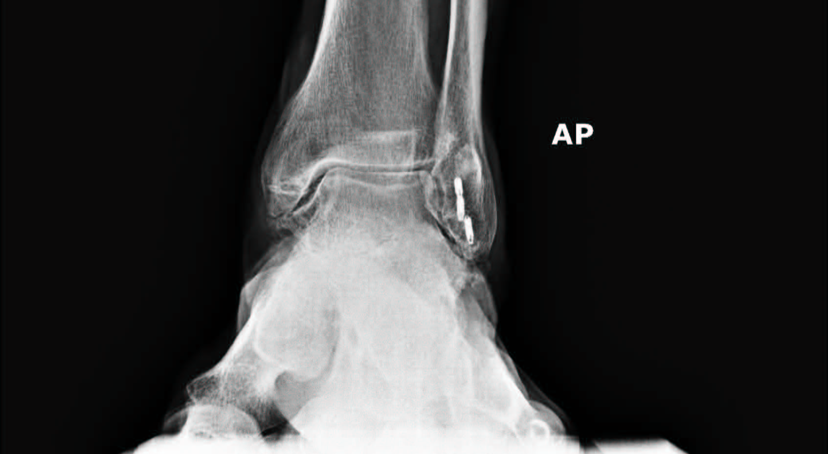 Tar Injury Test Your Knowledge: TAR Fundamentals