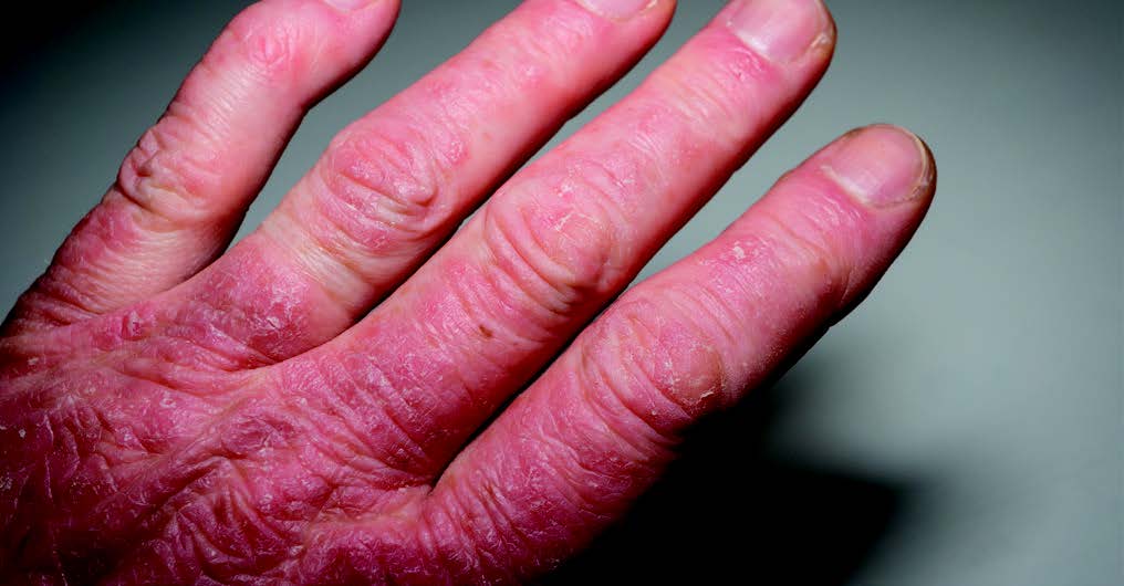 Musculoskeletal Ultrasound Increases Speci  city for Diagnosing Psoriatic Arthritis