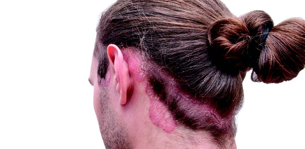 Deep Learning Model Discriminates Between Scalp Psoriasis and Seborrheic Dermatitis