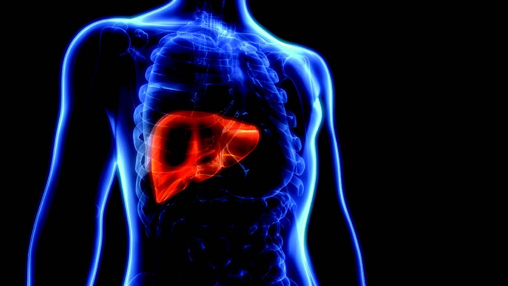 Patients With Psoriasis at Risk for Advanced Liver Fibrosis