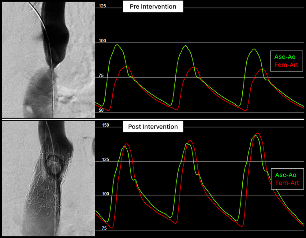 Figure 1. Pre- and postintervention aortic angiography