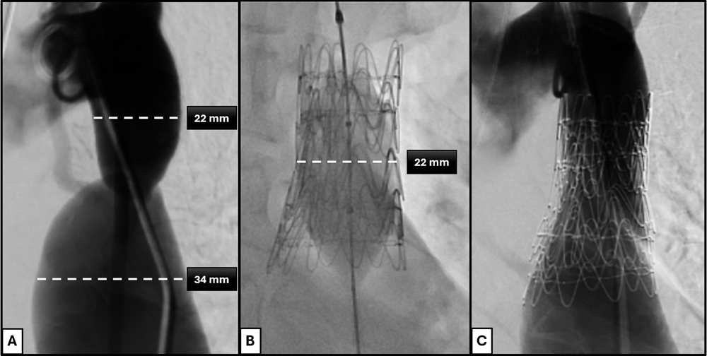 Figure 2. Pre- and postintervention aortic angiography