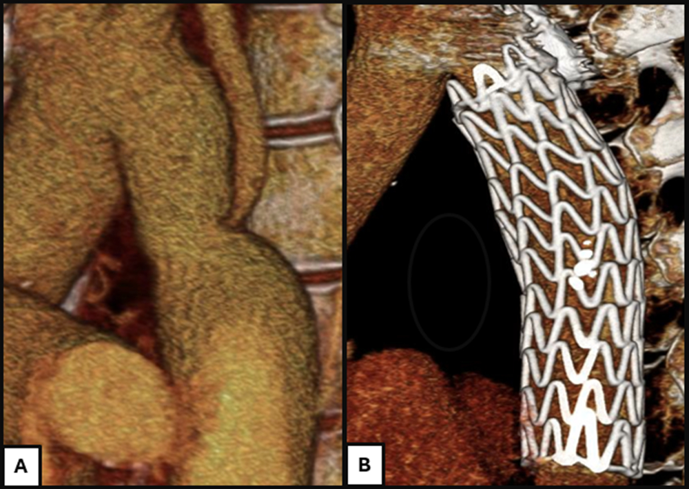 Figure 3. Pre- and postintervention cross-sectional imaging