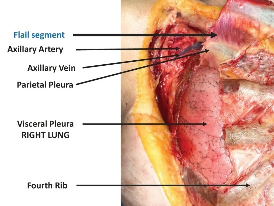 Figure 1: Flail chest segment shown within close proximity to the lung (Photo: Centre for Emergency Health Services) 