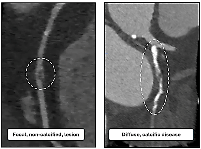Figure 1. Coronary computed tomography angiograms (CCTA)