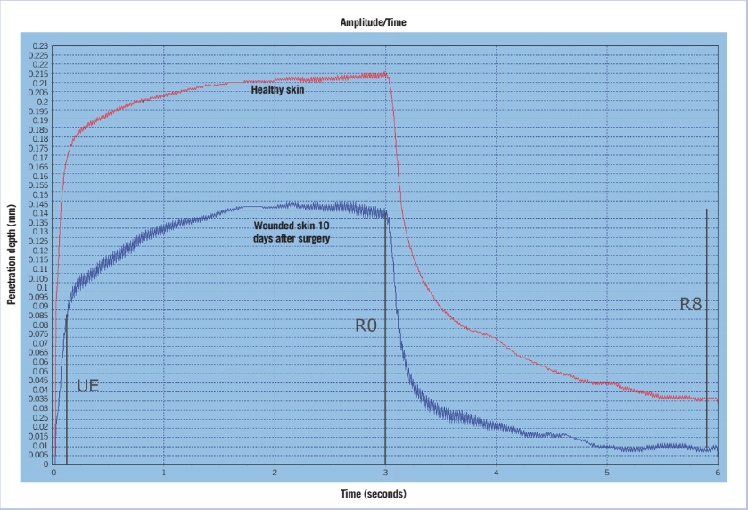 A visual demonstration of the elasticity measurement device skin deformation-time curve with an application of 450 mbar load for 3 seconds (ie, on-time) followed by a relaxation time of another 3 seconds (ie, off-time). For this measurement, the time-strain mode (Modus 1) and a measuring probe with an aperture of 6 mm were used. Calculated elasticity (UE), firmness of skin (R0), and overall elasticity (R8) were generally assumed to be the most representative values for skin elasticity