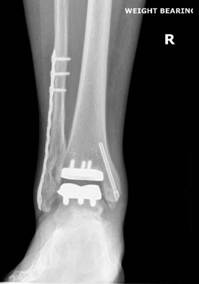 Figure 5. Six months postoperative radiograph