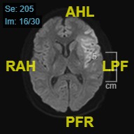 Figure 1. Diffusion-weighted magnetic resonance image showing acute infarct in the left middle cerebral artery territory involving the insular cortex and adjacent frontal and temporal operculum.