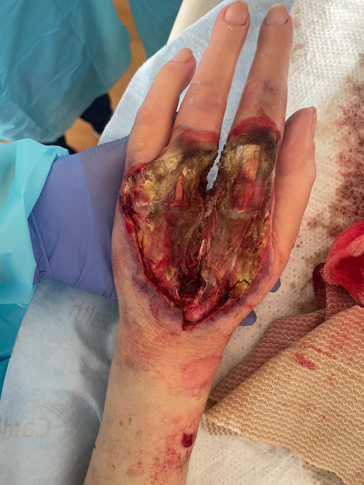 A Case of Upper Extremity Gangrene Likely Secondary to Mucormycosis, image size:1200x1600