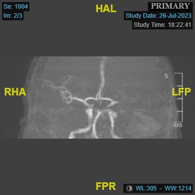 Figure 2. Magnetic resonance angiography maximum intensity projection image showing cutoff of the left M1 middle cerebral artery.