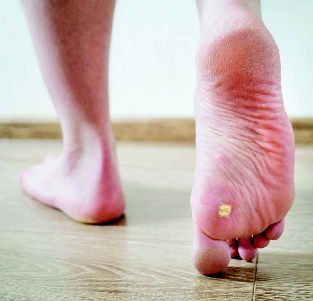Treating Plantar Warts and Molluscum at Home