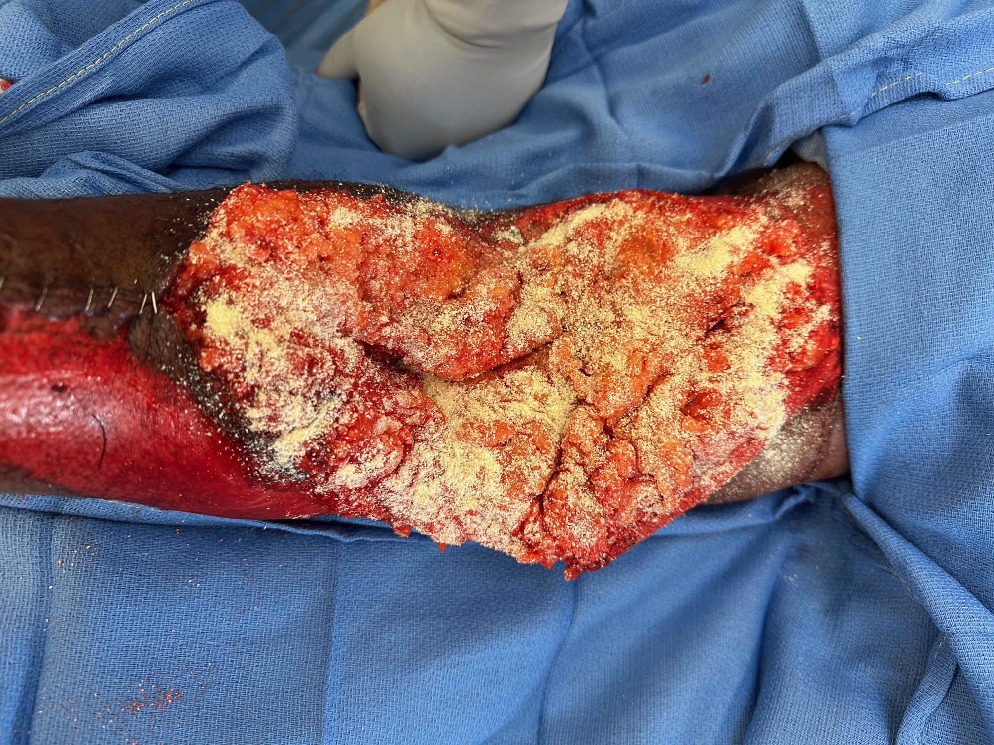 Application of porcine-derived extracellular matrix powder to free omental flap. 