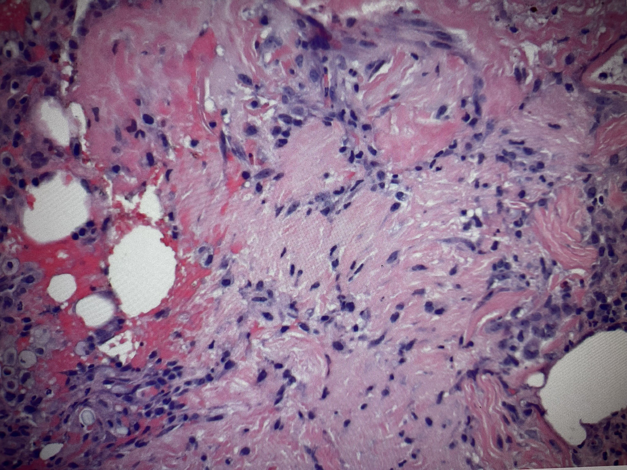 Histological sectioning of granulation tissue illustrating neovascularization and collagen deposition within a fibrin network.