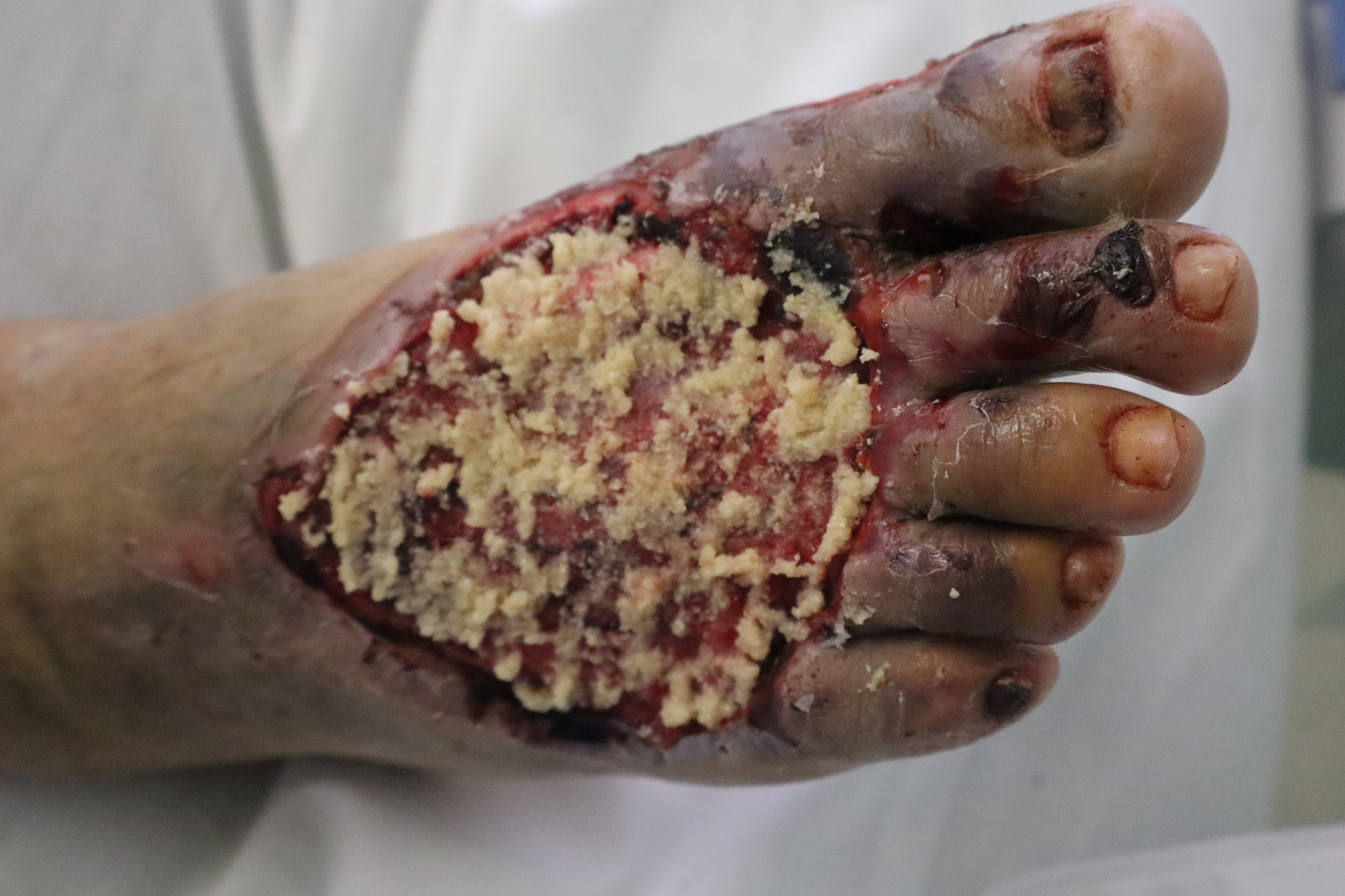 Figure 2. Application of porcine-derived extracellular matrix powder. 