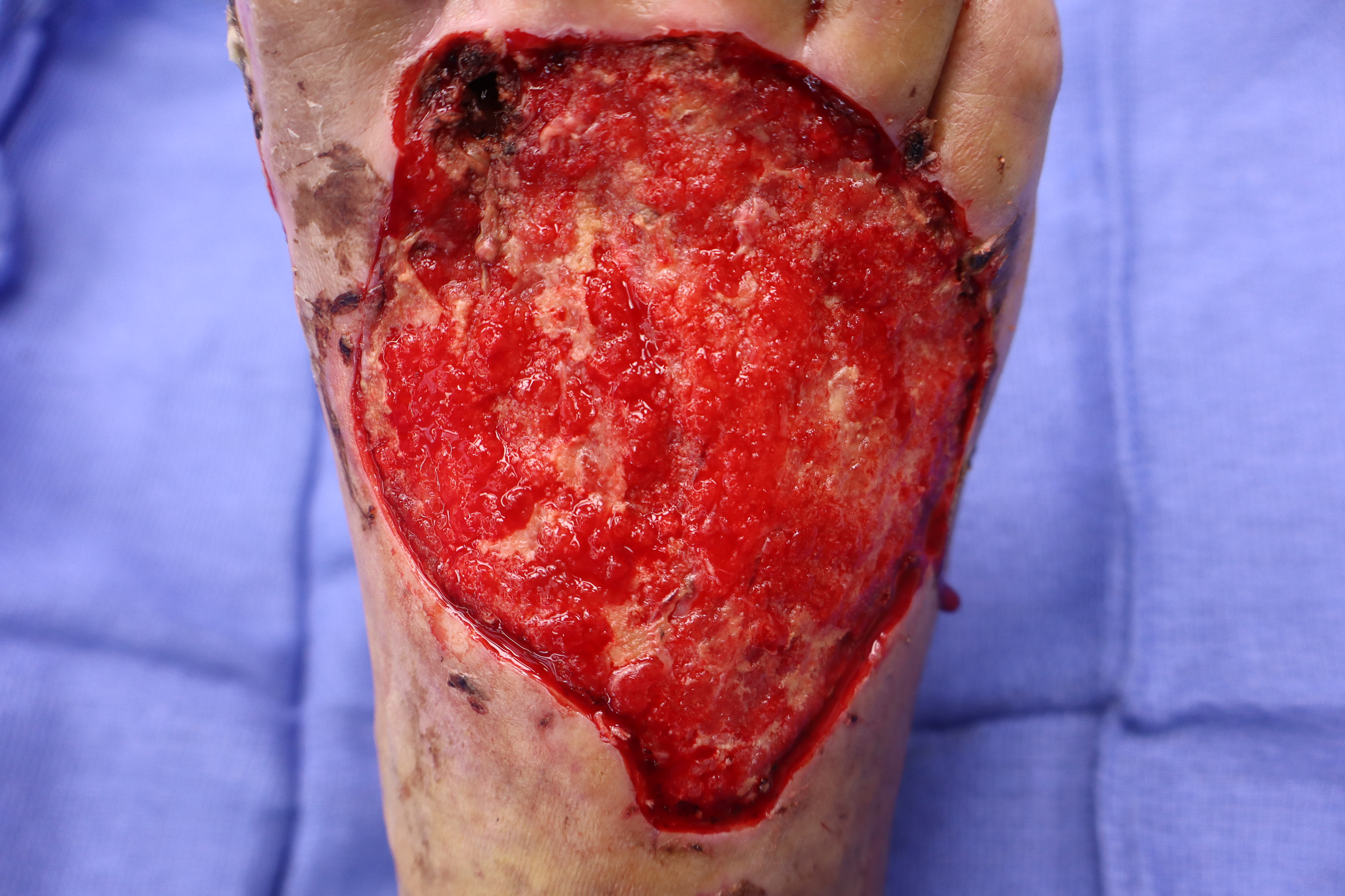 Robust granulation tissue present over the wound bed at post-application day 11.