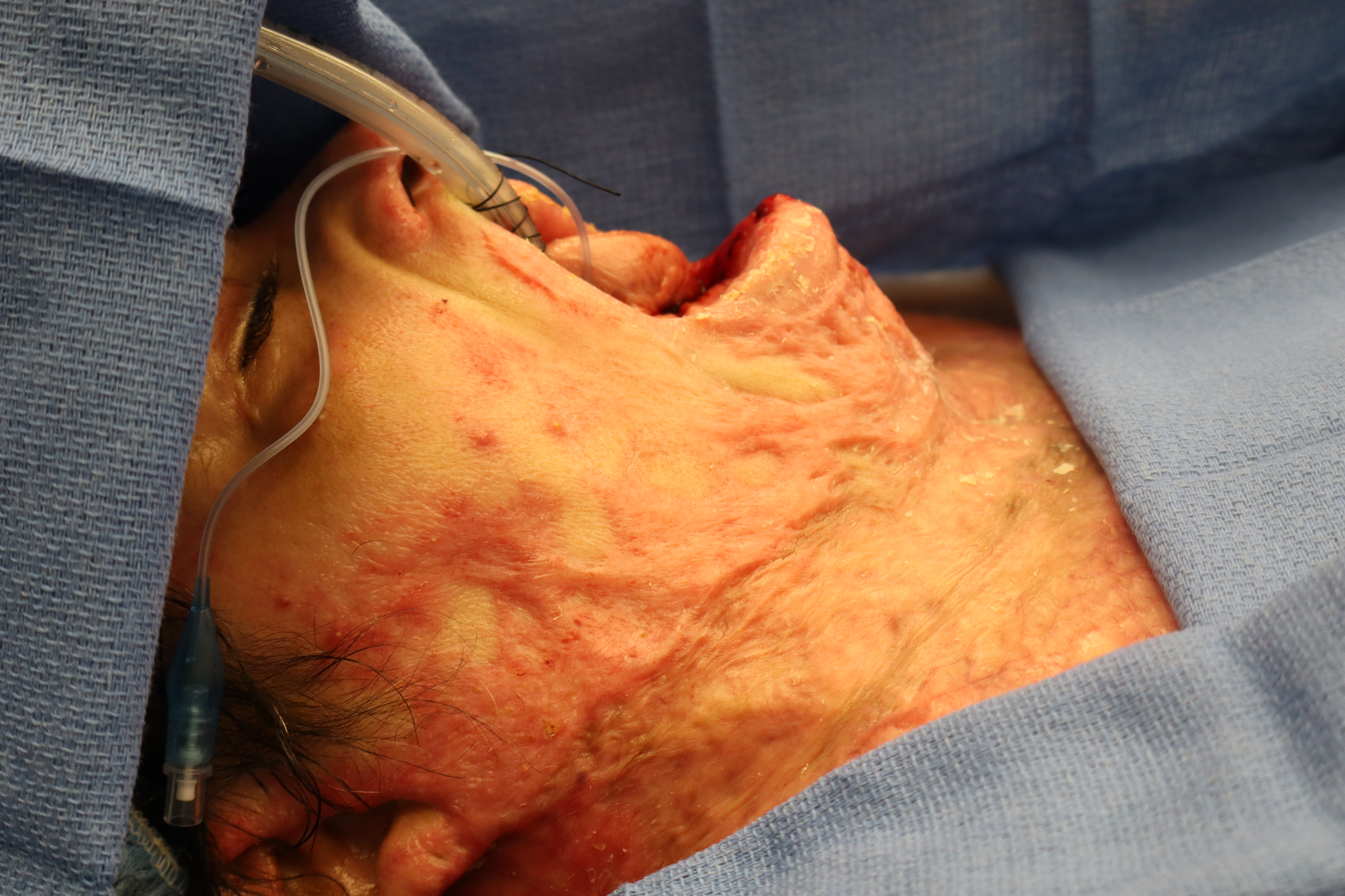 Severe neck burn contracture prior to excision with reconstruction.