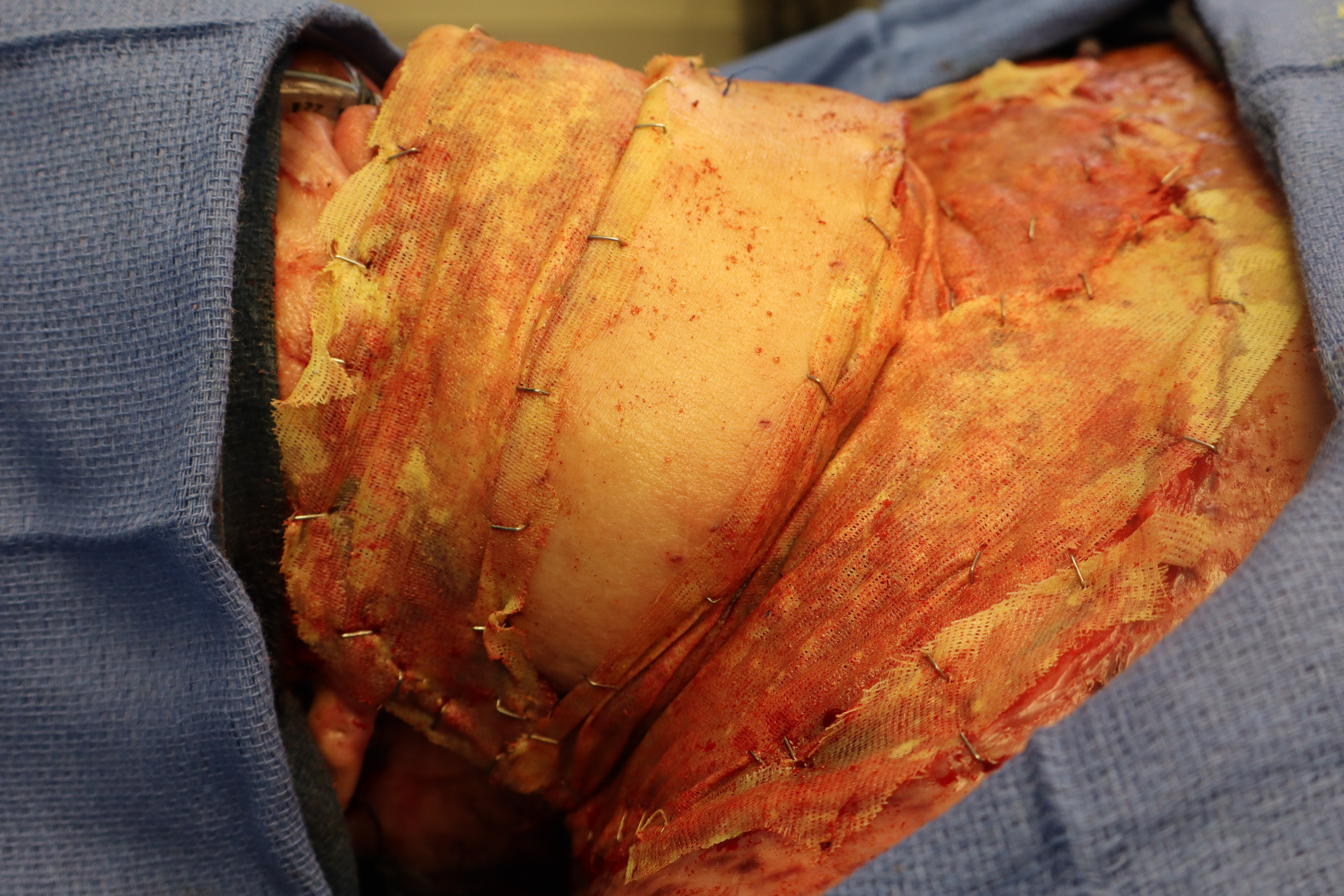 Reconstruction of neck defect with latissimus dorsi myocutaneous flap with application of porcine-derived extracellular matrix powder and gauze dressings.