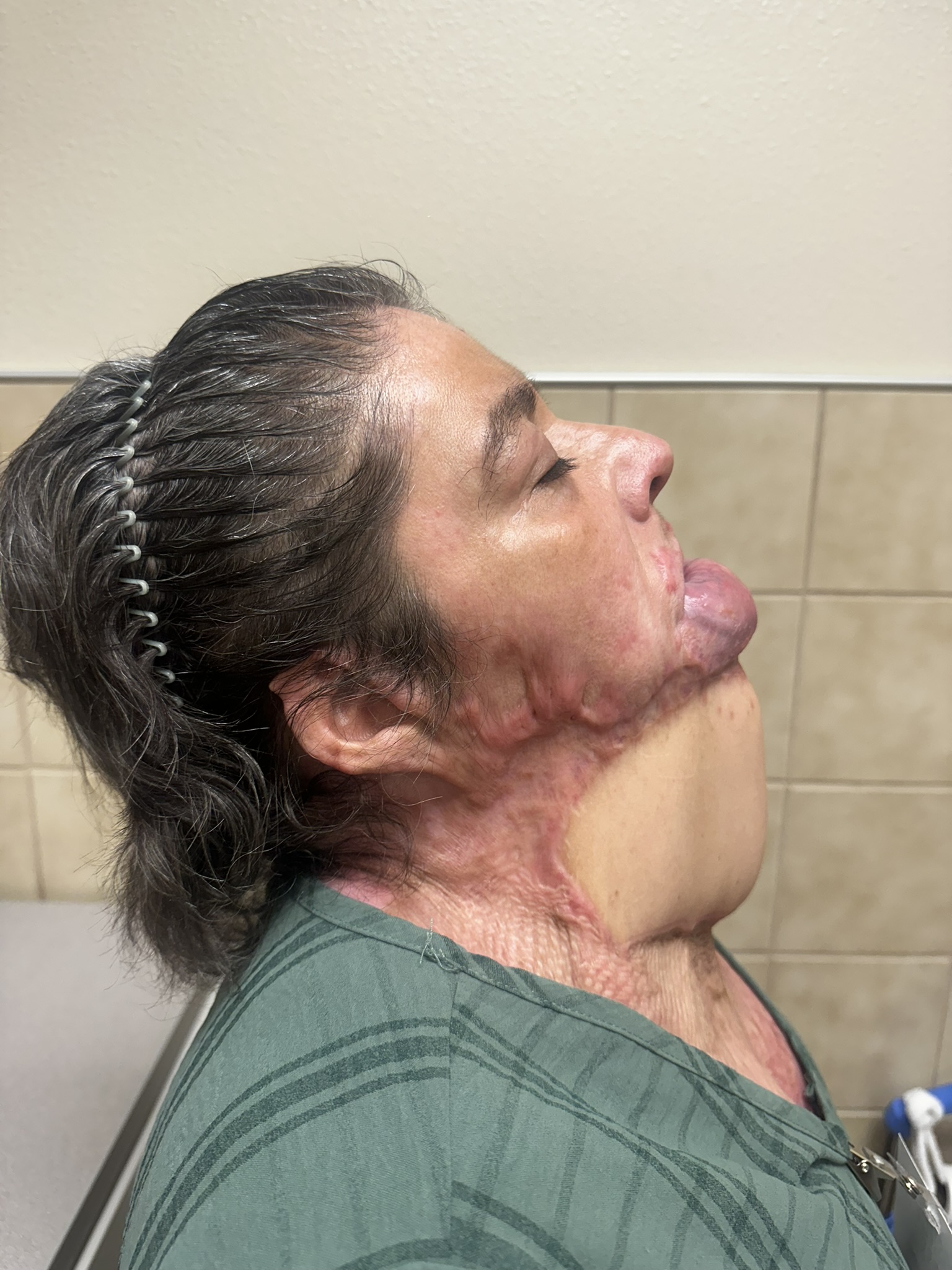 Surgical site 3 months postoperative showing skin graft adherence with improved range of motion. 