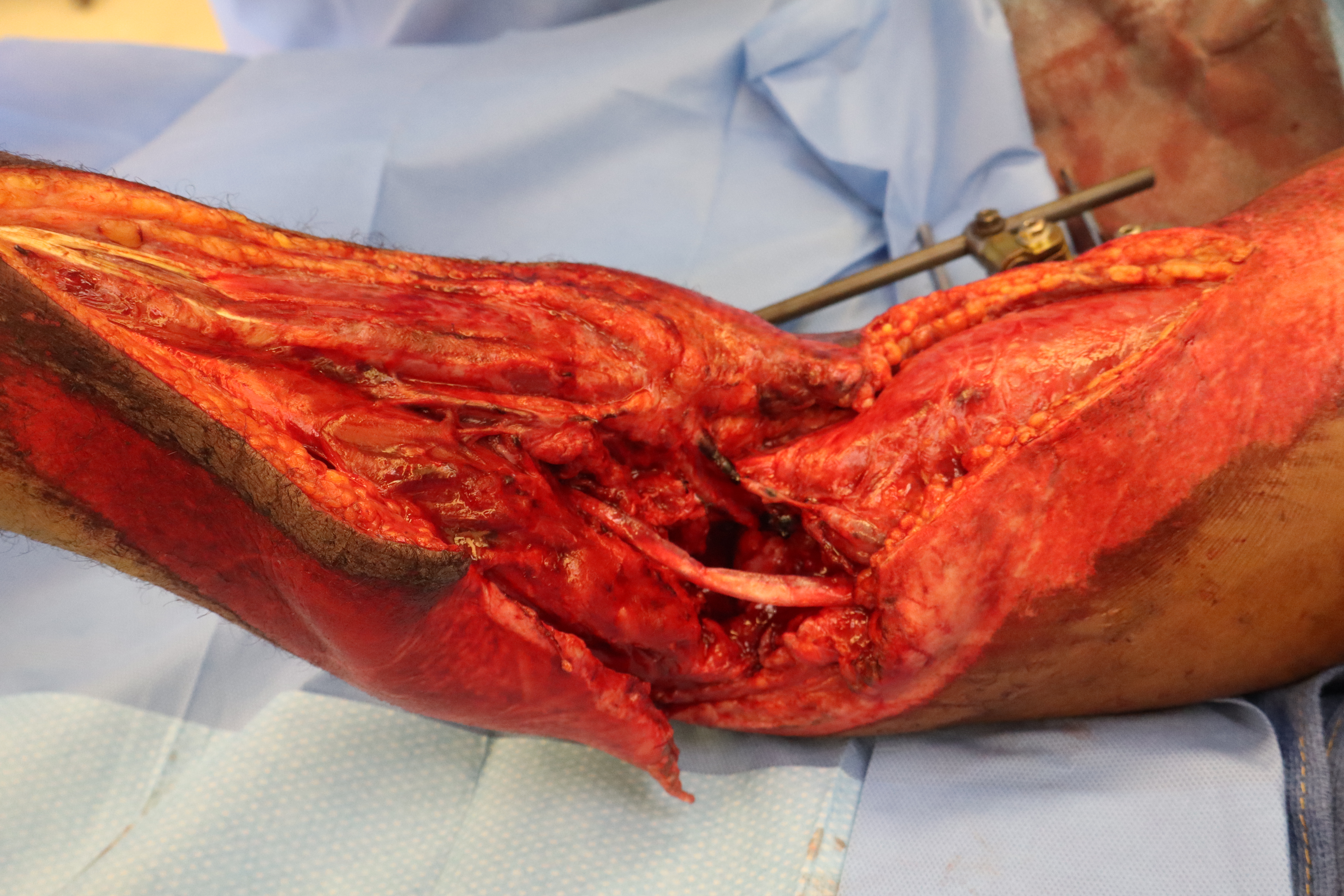  Initial right upper extremity traumatic defect with exposed radial nerve and radial artery.