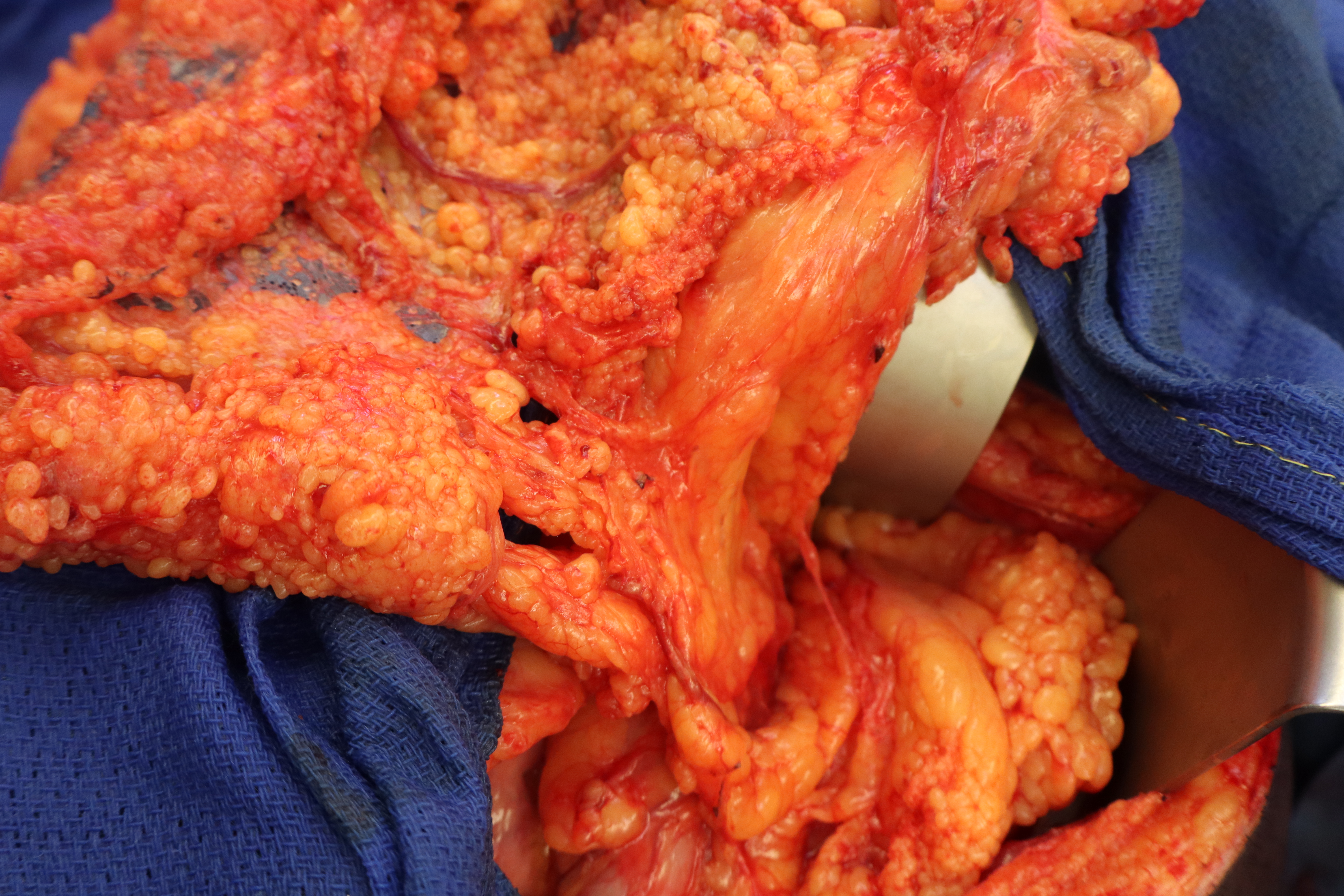 Omental flap harvest.