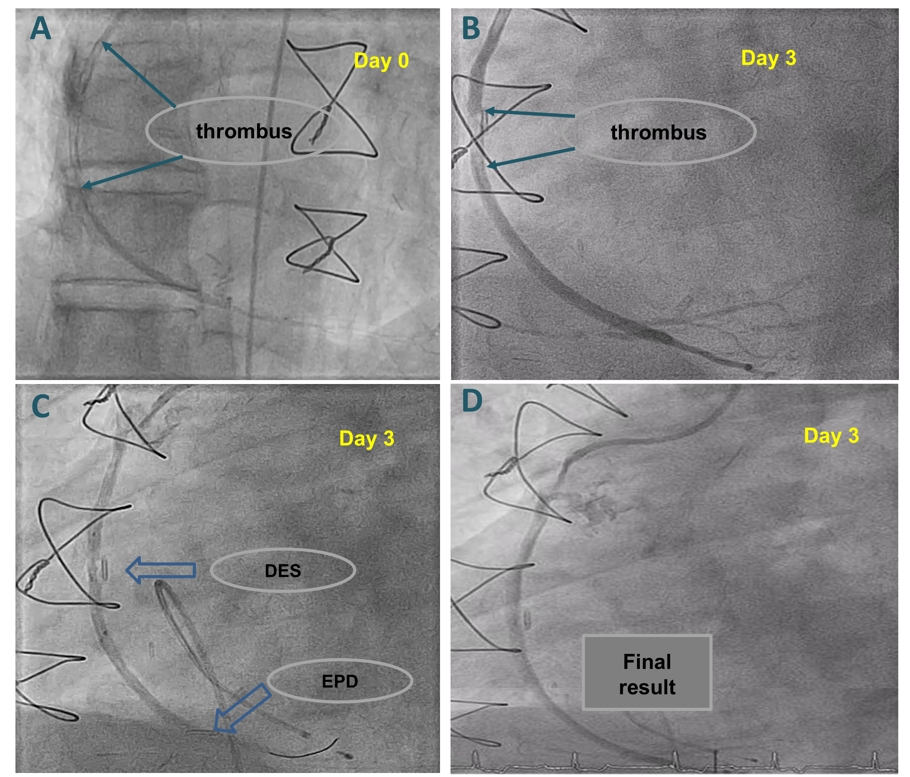 Figure. Coronary angiography illustrated a thrombotic 