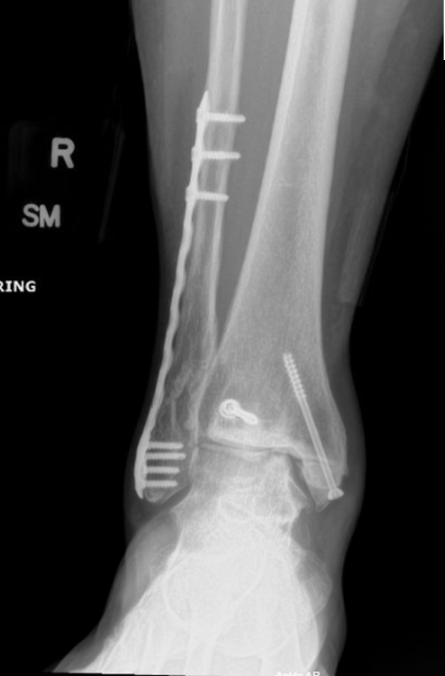 Preop radiograph