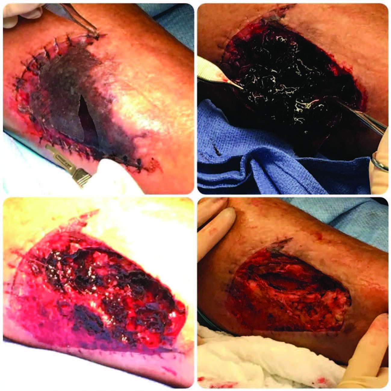 These photos illustrate sequential steps in evacuation of a deep dissecting hematoma in a patient who sustained a skin tear fr om a fall off a ladder.